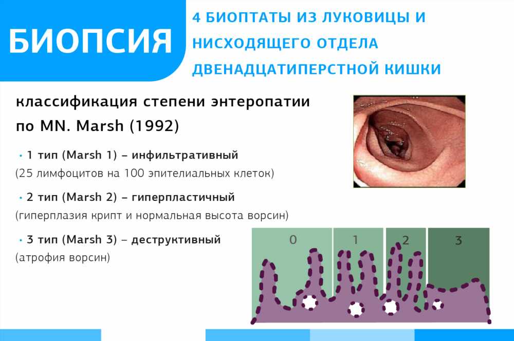 Целиакия: Важность анализов на антитела и генетическая диагностика для точного диагноза