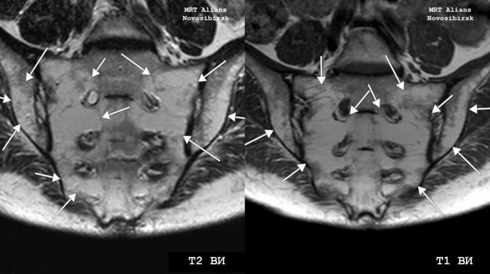 Диагностика МРТ крестцово-подвздошных сочленений: подготовка и особенности исследования