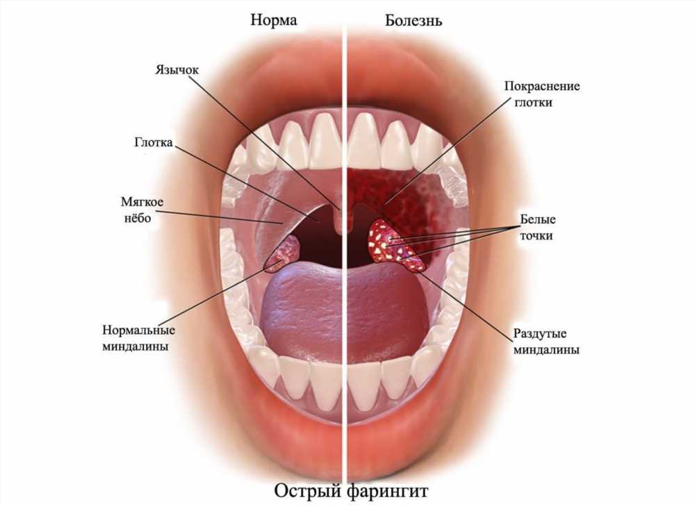 Эффективное лечение боли в горле антибиотиками: советы и рекомендации