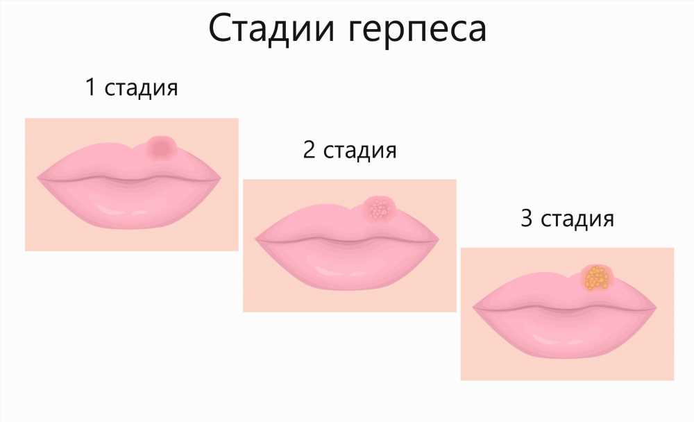 Эффективное лечение герпеса народными средствами: безболезненно и быстро