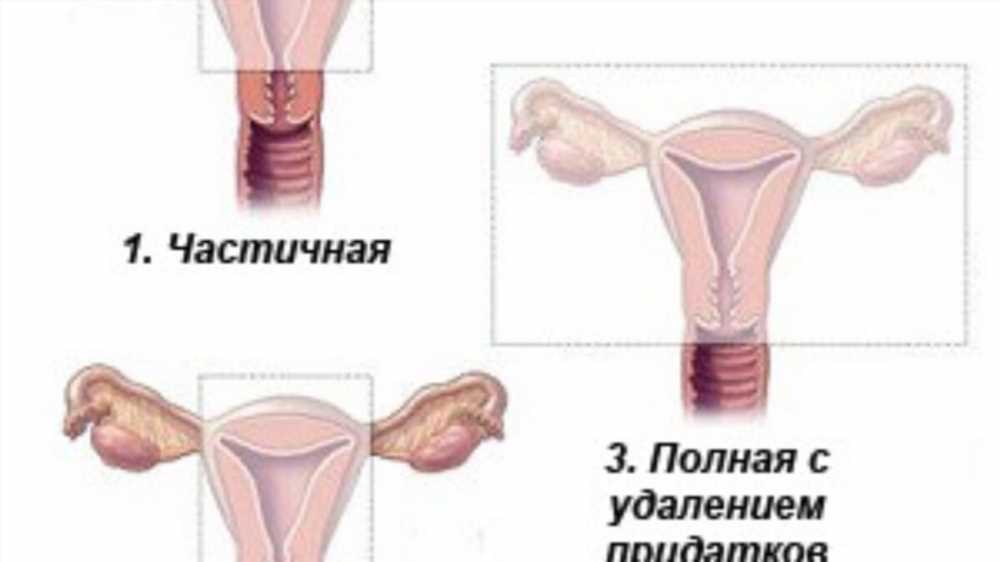 Экстирпация матки: Методы выполнения и важные аспекты