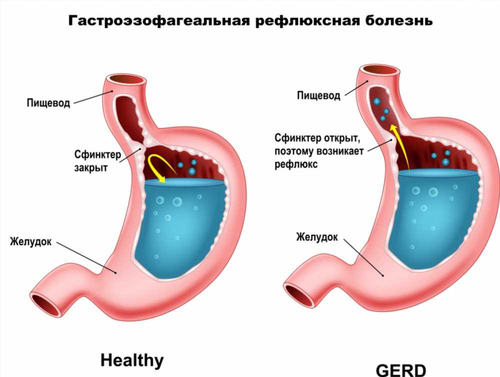 Желудочный вирус: симптомы, лечение и профилактика