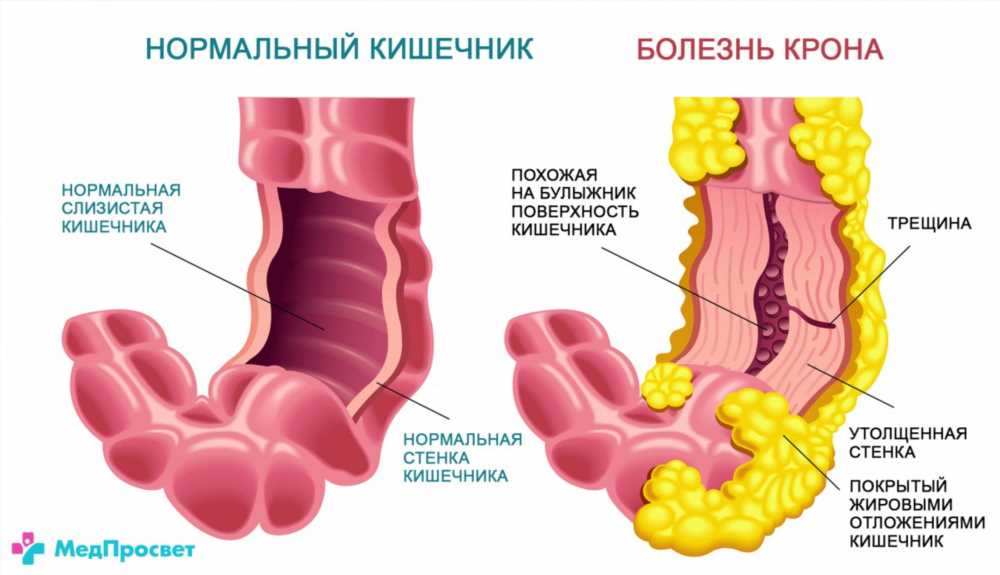 Курение и болезнь Крона: Подробный обзор опасности и последствий