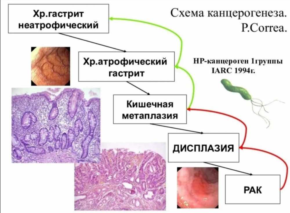 Методы диагностики и лечения метаплазии: Понимание, Подходы и Перспективы