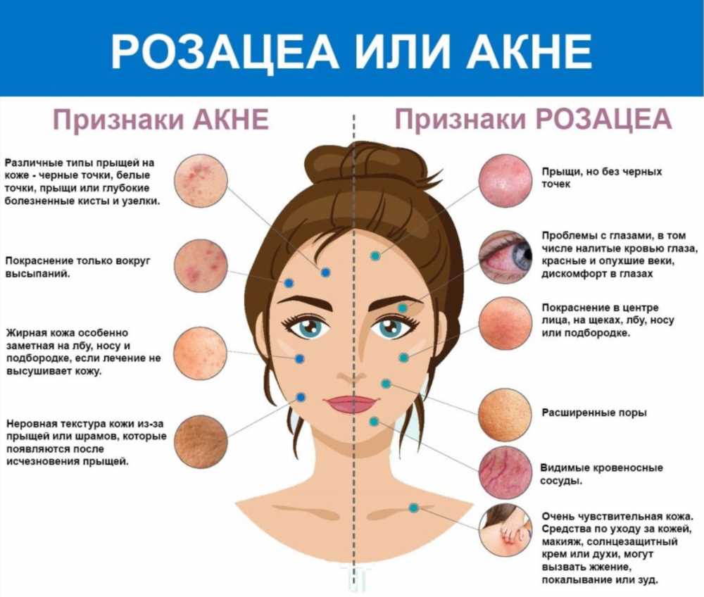 Полное руководство по диагностике розацеа: симптомы, методы диагностики и лечение