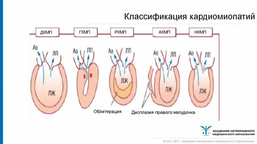 Причины атрофических изменений в сердце: влияние факторов на здоровье сердечной мышцы