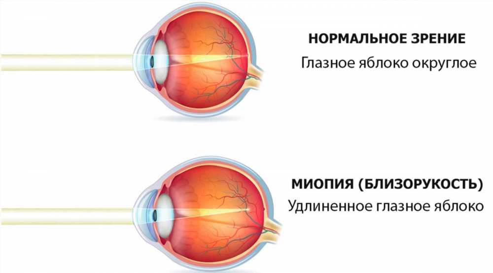 Причины дальнозоркости у детей: основные факторы и механизмы развития