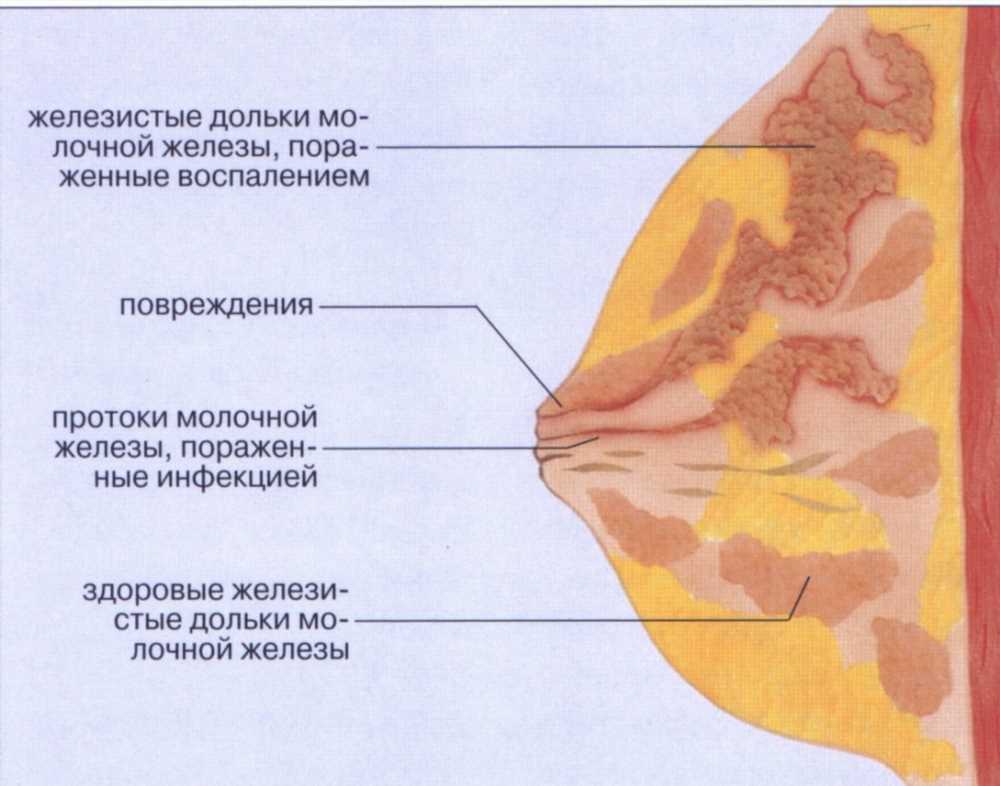 Простой лактостаз: признаки, причины и лечение