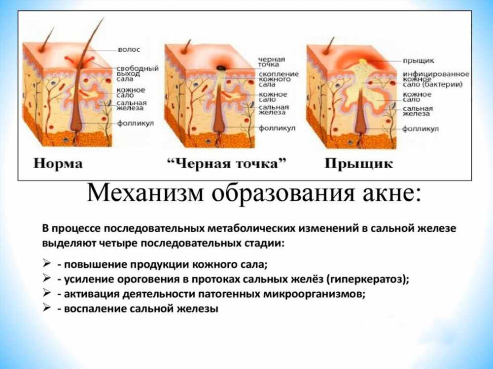 Прыщи: Причины и Механизм Образования