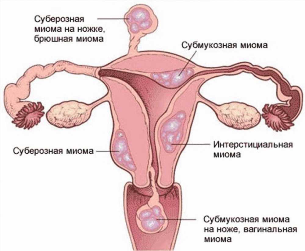 Увеличение матки: причины и последствия