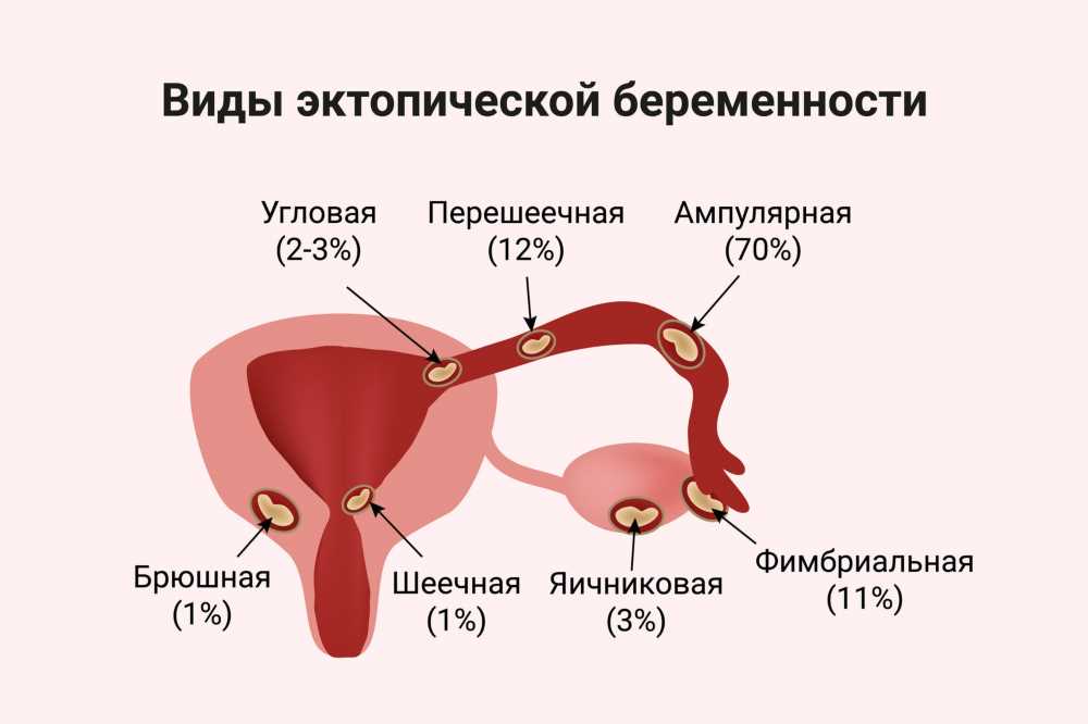 Внематочная беременность: причины, симптомы, диагностика и лечение