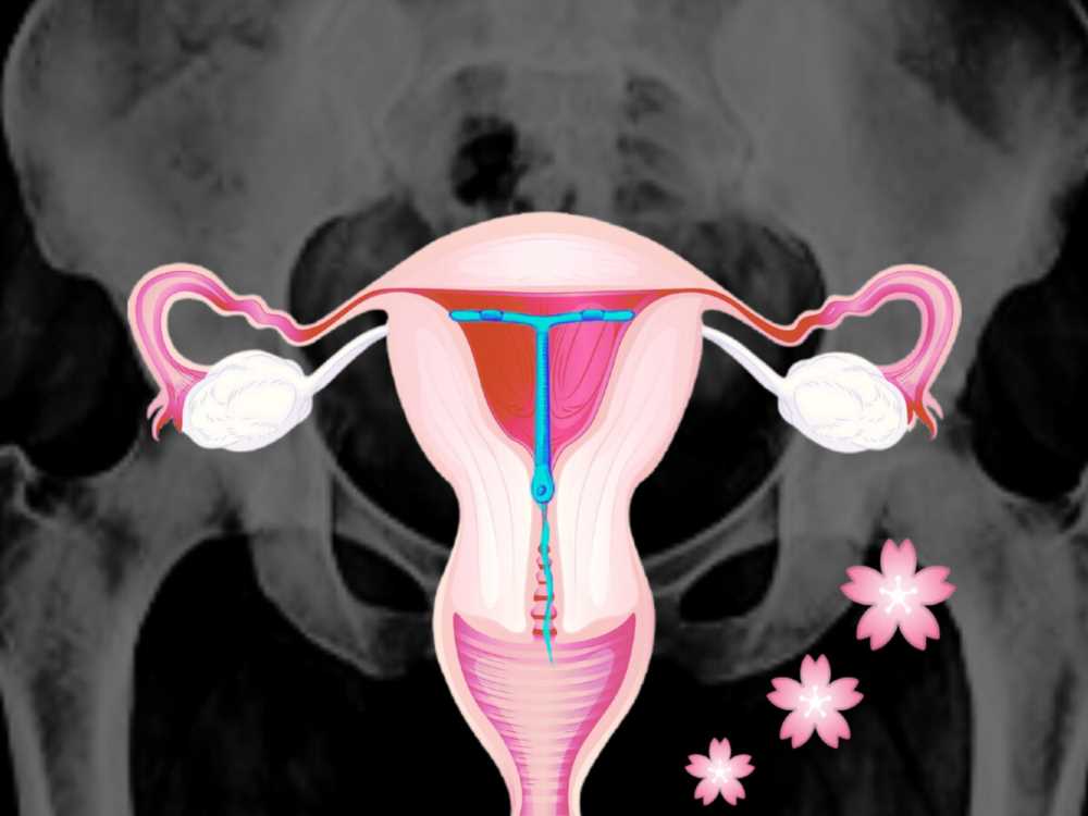 Внутриматочная спираль (ВМС): Принцип действия и эффективность для контрацепции