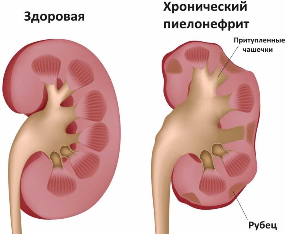 Воспаление Почек: Симптомы, Причины и Эффективное Лечение