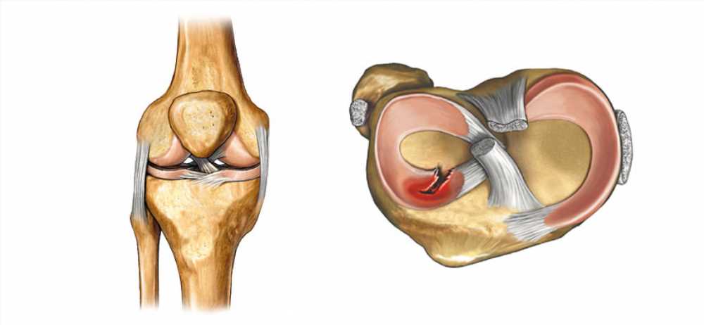 Восстановление после удаления мениска: Последствия, реабилитация и зашивание