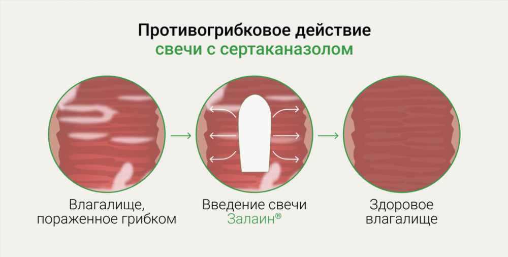 Выбор противозачаточных свечей: виды, принципы действия и правильное применение